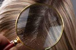 ما علاج قمل الشعر؟