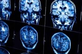 الذكاء يجعلك أكثر عرضة لسرطان الدماغ!