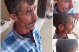 إصابة فلسطيني باعتداء للمستوطنين جنوب غرب جنين