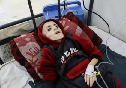 ارتفاع عدد ضحايا سوء التغذية في قطاع غزة إلى 18 شهيد