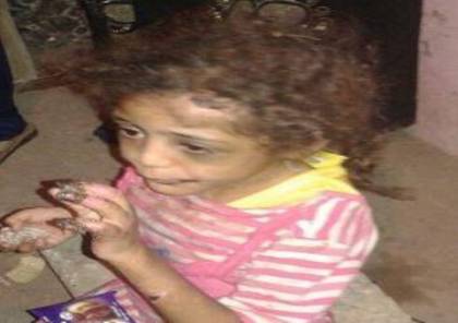 بالصور.. مصري يعذب طفلته حرقاً والسبب صادم