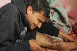 المشوخي بعد تهديد الاطباء بقطع رجله وصل عمان وتناول وجبة “منسف بمبادرة من اهالي المخيمات