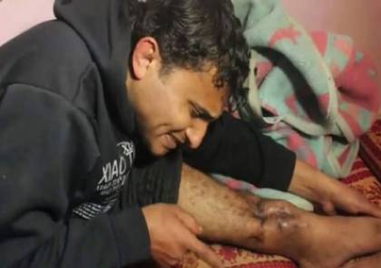 المشوخي بعد تهديد الاطباء بقطع رجله وصل عمان وتناول وجبة “منسف بمبادرة من اهالي المخيمات