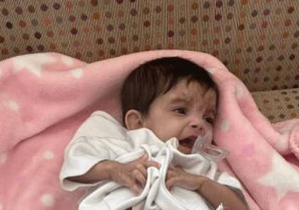 السعودية تجري عملية فصل لتوأم الطفيلي اليمني..كم تستغرق العملية ؟