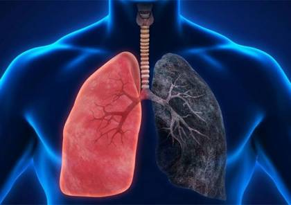 الصحة: 70% من مرضى سرطان الرئة في فلسطين هم من المدخنين والمدخنين السابقين