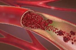 دعامات الأوعية الدموية أعظم إنجاز في مجال الطب