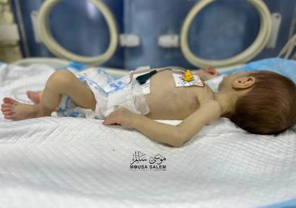شمالي غزة.. الجوع والمرض ينهش جسد الرضيعة جنيد 