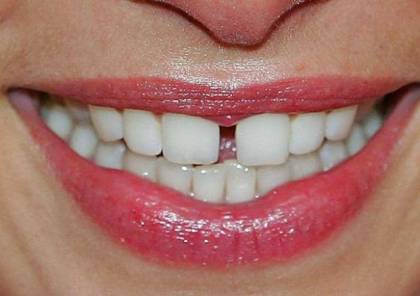 لإزالة جير الأسنان.. 10 طرق طبيعية لا غنى عنها