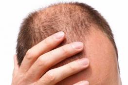 الحل الأمثل لعلاج تساقط الشعر