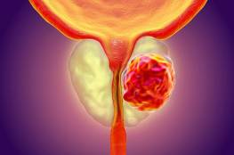 العلماء يزعمون أن "أدوية شائعة" يمكن أن تقلل من احتمالات إصابة الرجال بسرطان البروستات!