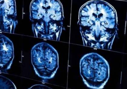 الذكاء يجعلك أكثر عرضة لسرطان الدماغ!
