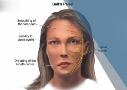 "الوجه الآلي" تقنية جديدة لعلاج شلل الوجه النصفي