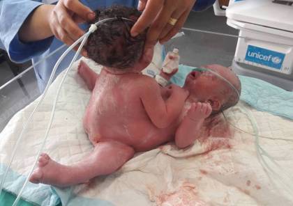 صور..حالة ولادة نادرة لتوأم "سيامي" بمجمع الشفاء الطبي بغزة