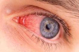 6 أسباب وراء احمرار العين
