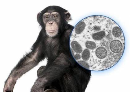 إليك كل ما نعرفه حتى الآن عن مرض "جدري القرود"...