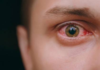 خمسة أسباب شائعة لاحمرار العين.. تعرف عليها
