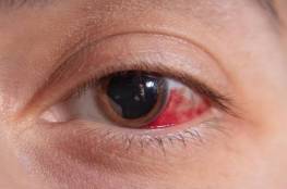 علاج احمرار العين في المنزل بطرق فاعلة