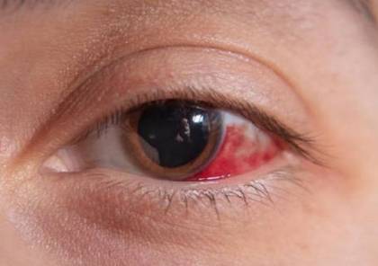 علاج احمرار العين في المنزل بطرق فاعلة