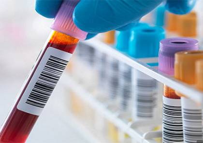 ثورة علمية : اختبار دم جديد يحدد فرص البقاء على قيد الحياة
