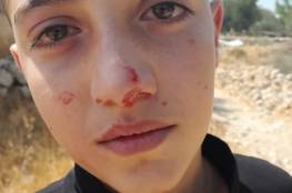 إصابة طفل في اعتداء للمستوطنين في الخليل