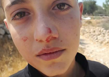 إصابة طفل في اعتداء للمستوطنين في الخليل