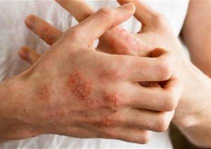 مشكلة جفاف الجلد فى الشتاء .. طرق العلاج والوقاية