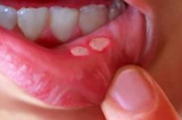 طريقة لعلاج قرح الفم خلال ساعات