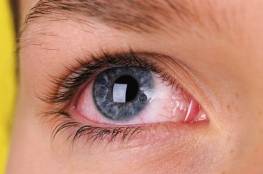 أعراض العين الوردية والحساسية؟
