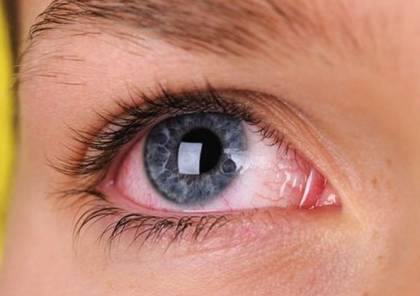 أعراض العين الوردية والحساسية؟