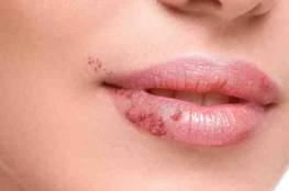 10 طرق لعلاج قرح الفم بدون استشارة طبيب