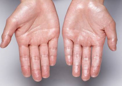 علاج تعرق اليدين: أهم الطرق الطبية والطبيعية