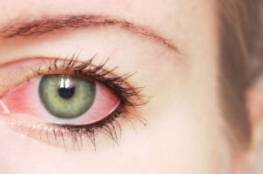 8 أعراض لالتهاب ملتحمة العين