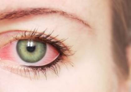 8 أعراض لالتهاب ملتحمة العين