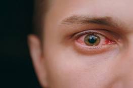 أمراض العيون تكشف وجود طفيليات في الجسم