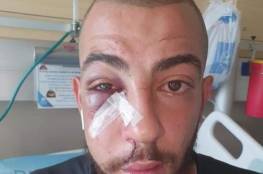 إصابة شاب بجروح وكسور إثر اعتداء الاحتلال عليه في القدس