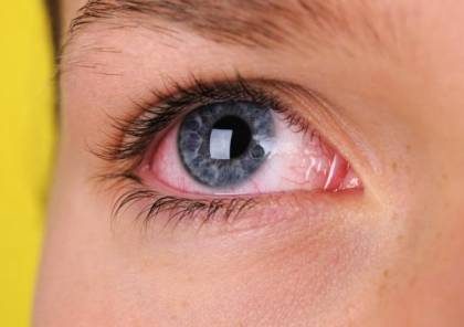 العين تعطي علامات على إصابة أعضاء الجسم بالأمراض