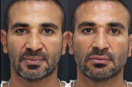 أحمد سعد يكشف سبب إجرائه جراحة تجميلية في وجهه
