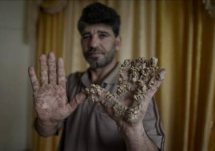 غزة ..مواطن مصاب بمرض “رجل الشجرة” النادر