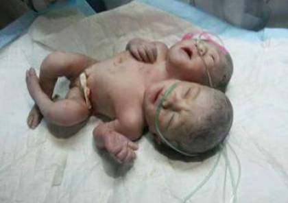 غزة : وفاة التوأم السيامي المولود برأسين بمستفى الشفاء