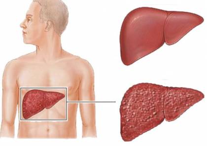 الكشف عن فيروس الكبد "سي" عبر البول