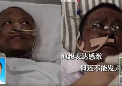 كورونا : طبيبان صينيان استيقظا بعد أسابيع من المرض وقد استحال لونهما إلى السواد