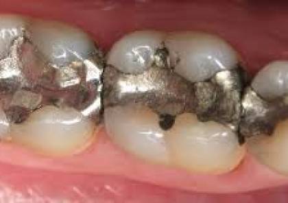 الاحتلال يمنع إدخال حشوات الأسنان إلى غزة بزعم انها مزدوجة الاستخدام