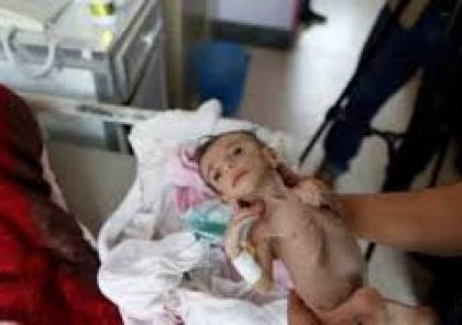 اليمن: وفاة ألف طفل يومياً بسبب "العدوان والحصار"