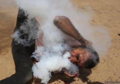 صحة غزة تكشف عن هوية "مصاب قنبلة الغاز في وجهه" وحالته الصحية