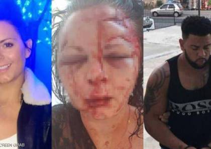 "اعتداء وحشي" يبدل ملامح شابة بريطانية في تركيا
