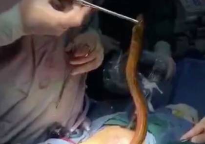 فيديو: استخراج ثعبان من جسم مريض .. كيف دخل؟ 