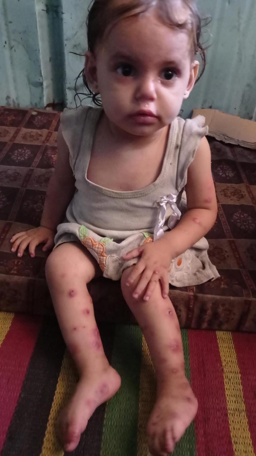 خيام النازحين في غزة تتحول إلى بؤر عدوى